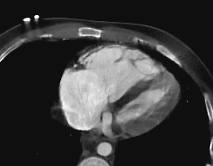 Axial CT of the chest at heart level, with a small target drawn on the left ventricular wall and a much larger amber contour around it covering the target's motion.